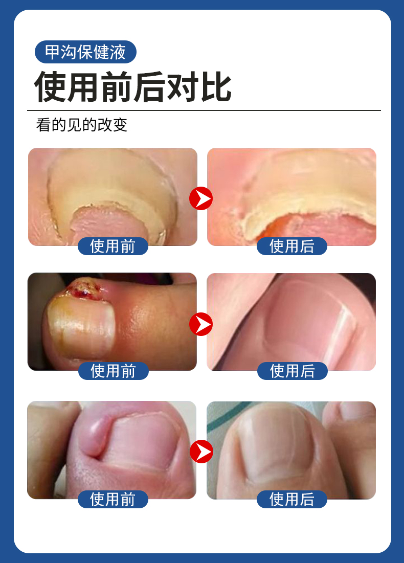 甲溝炎專用液有用嗎？使用前后對比